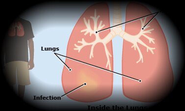 What is Bacterial Pneumonia